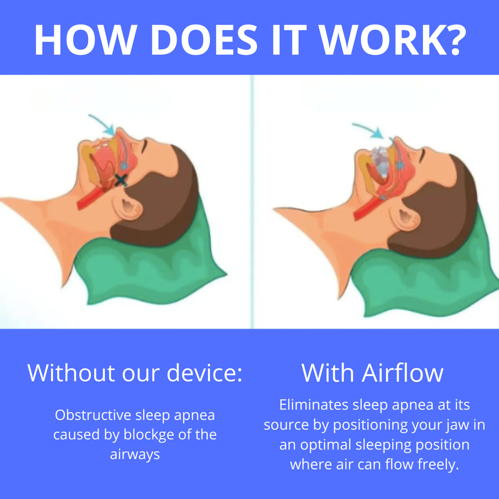Mion™- Mouthpiece for snoring and sleep apnea